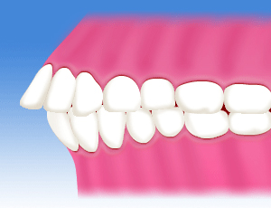 出っ歯、上顎前突<